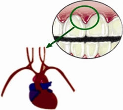 The relationship of periodontal disease to cardiovascular diseases — Review of literature